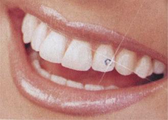 Bijuterii dentare (Skyce)