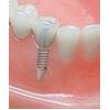  Implante dentare  - Implante Dentare
