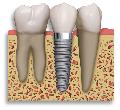 Implanturi dentare Bicon - SUA