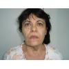 Lifting chirurgical pentru fata