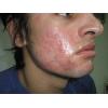 Peeling chimic acnee