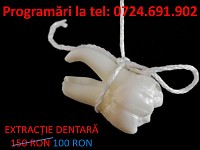 Extractie dentara!